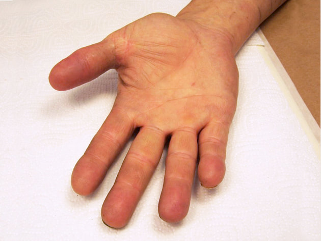 Fingers, Hands & Arms - Functional Restorations